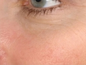 Cosmetic Dermatology Before & After Gallery - Patient 20493279 - Image 2