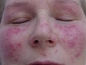 Cosmetic Dermatology Before & After Gallery - Patient 20493821 - Image 1