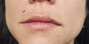 Lip Augmentation Before & After Gallery - Patient 20493823 - Image 1