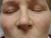 Cosmetic Dermatology Before & After Gallery - Patient 20493821 - Image 2