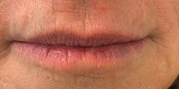 Lip Augmentation Before & After Gallery - Patient 20493824 - Image 1