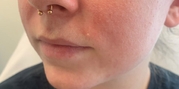 Lip Augmentation Before & After Gallery - Patient 20493825 - Image 1