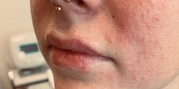 Lip Augmentation Before & After Gallery - Patient 20493825 - Image 2