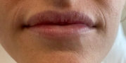 Lip Augmentation Before & After Gallery - Patient 20493830 - Image 1