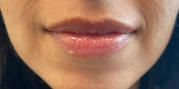 Lip Augmentation Before & After Gallery - Patient 20493831 - Image 1