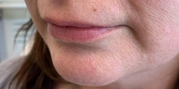 Lip Augmentation Before & After Gallery - Patient 20493832 - Image 1