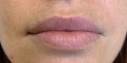 Lip Augmentation Before & After Gallery - Patient 20494377 - Image 1