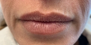Lip Augmentation Before & After Gallery - Patient 20494379 - Image 1