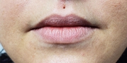 Lip Augmentation Before & After Gallery - Patient 20494381 - Image 1