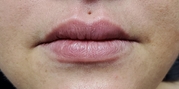 Lip Augmentation Before & After Gallery - Patient 20494381 - Image 2