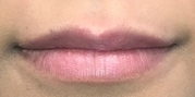 Lip Augmentation Before & After Gallery - Patient 20494384 - Image 1