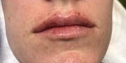 Lip Augmentation Before & After Gallery - Patient 20495372 - Image 2