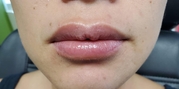 Lip Augmentation Before & After Gallery - Patient 20495373 - Image 2