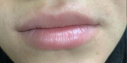 Lip Augmentation Before & After Gallery - Patient 20495374 - Image 1