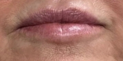 Lip Augmentation Before & After Gallery - Patient 20495378 - Image 1