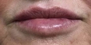 Lip Augmentation Before & After Gallery - Patient 20495378 - Image 2