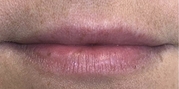 Lip Augmentation Before & After Gallery - Patient 20495379 - Image 1