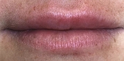 Lip Augmentation Before & After Gallery - Patient 20495379 - Image 2
