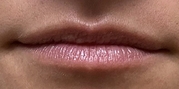 Lip Augmentation Before & After Gallery - Patient 20495381 - Image 1