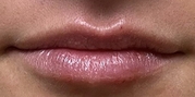 Lip Augmentation Before & After Gallery - Patient 20495381 - Image 2