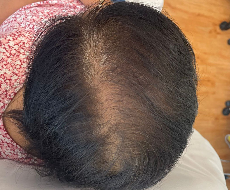 avalon prp hair restoration before