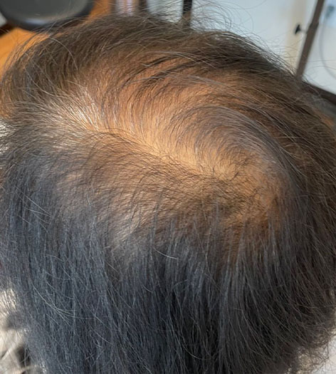 avalon prp hair restoration before