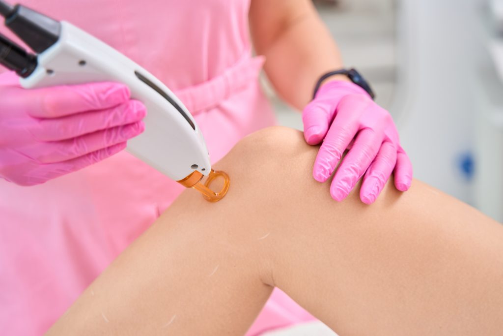 Laser Hair Removal San Diego treatment for legs