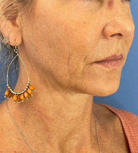 Cheek and Jaw Filler before