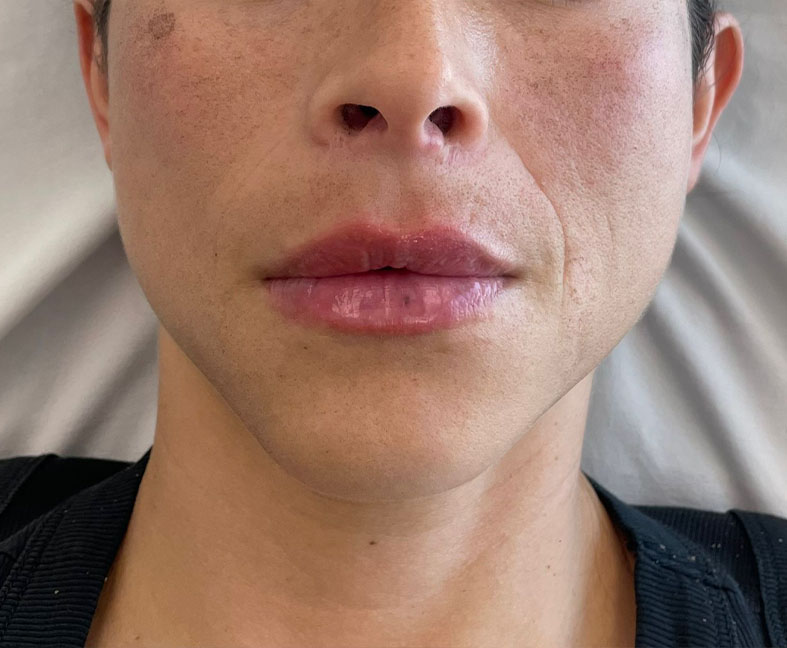 Lip Fillers after