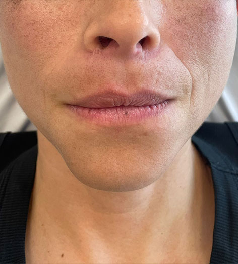Lip Fillers before