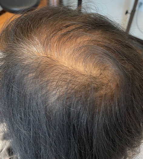 PHP Hair Restoration before