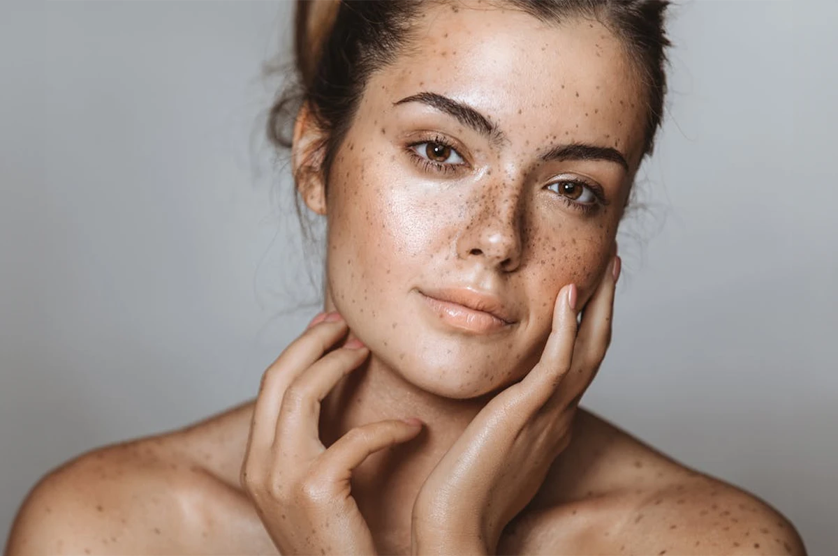 A person with freckles gently resting their hands on their face, looking at the camera